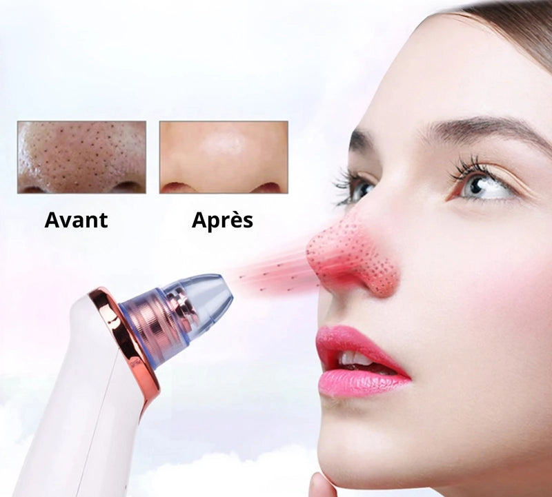 XR CLEANER : Aspirateur de points noirs